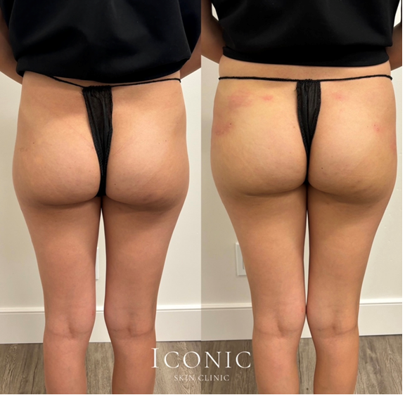 Non-Surgical BBL Image